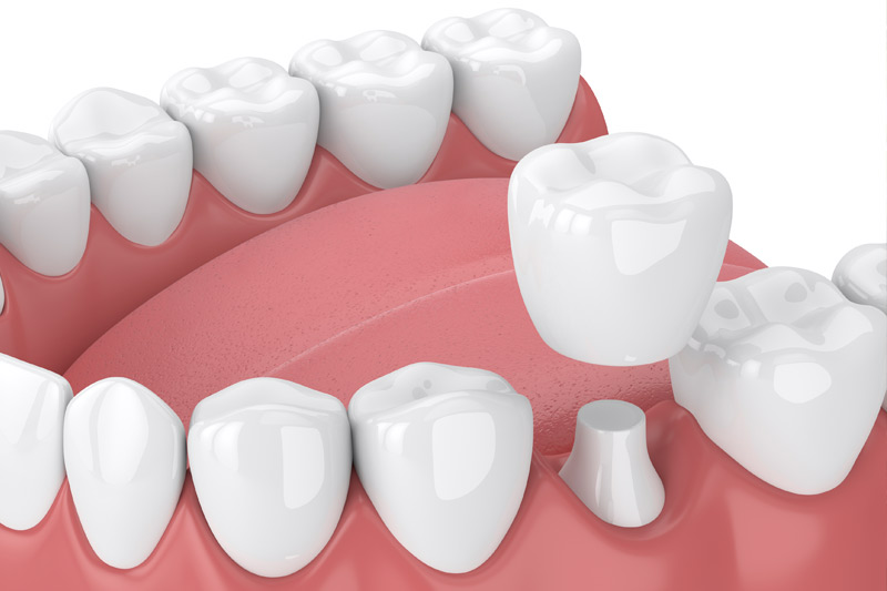 Dental Crowns in San Marcos