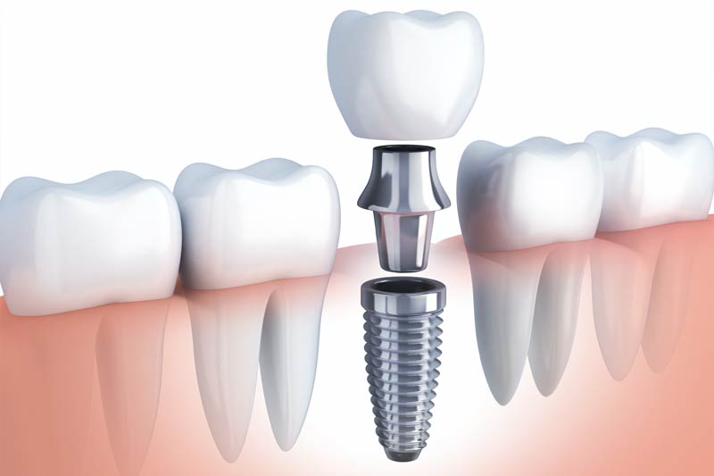 Implants Dentist in San Marcos